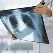 Identifying The Major Types of Pneumonia by Cause
