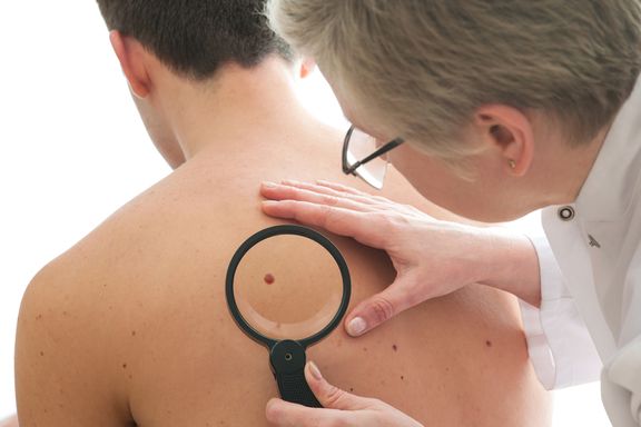 Signs and Symptoms of Non-Melanoma Skin Cancer