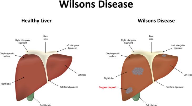 popular-causes-of-elevated-liver-enzymes-activebeat