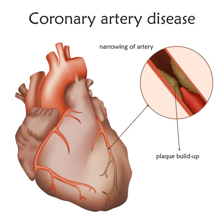 Common Causes of Atrial Fibrillation ActiveBeat