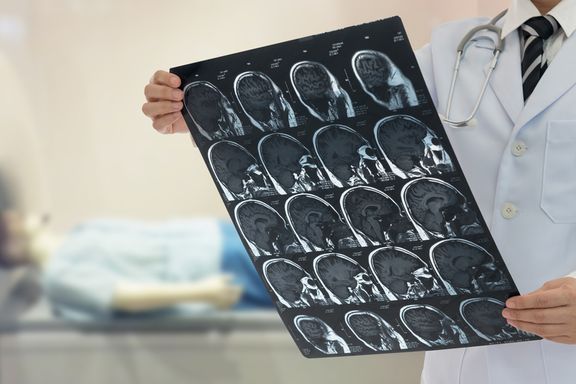 What to Know About a Transient Ischemic Attack or Mini-Stroke