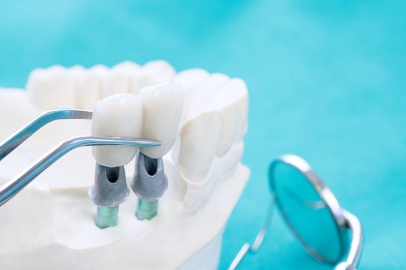 How Dental Implants Provide The Perfect Smile