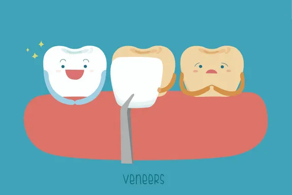 What to Know Before Getting Dental Veneers