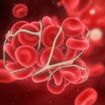Anzeichen für ein Blutgerinnsel (sowie Risikofaktoren, Behandlungsmöglichkeiten und mehr)