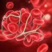Anzeichen für ein Blutgerinnsel (sowie Risikofaktoren, Behandlungsmöglichkeiten und mehr)
