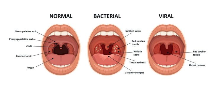 What To Know About Strep Throat Activebeat