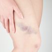 Reasons You Bruise So Easily