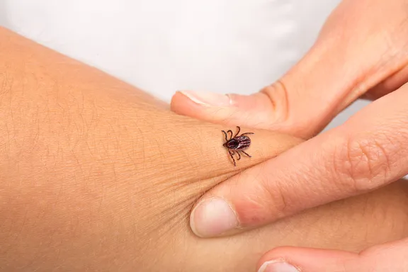 Signs and Symptoms of a Tick Bite