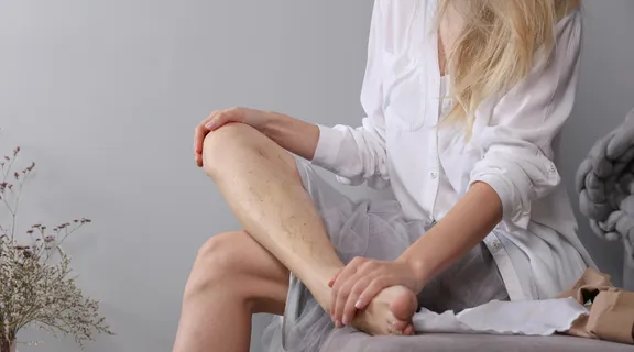 How To Prevent and Manage Varicose Veins