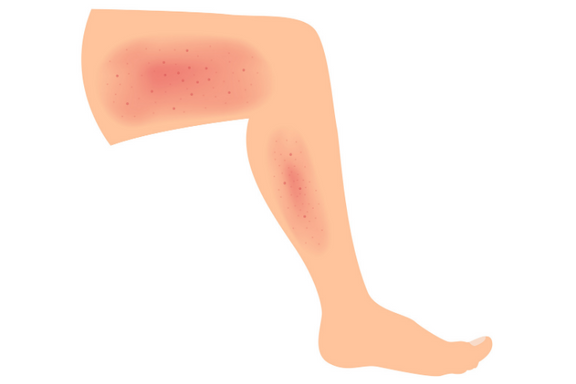 Cellulitis: Symptoms, Causes, and Treatment Options