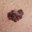 Everything You Need to Know About Melanoma