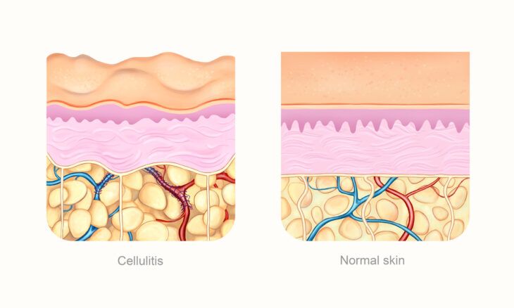Cellulitis: Symptoms, Causes, and Treatment Options - ActiveBeat