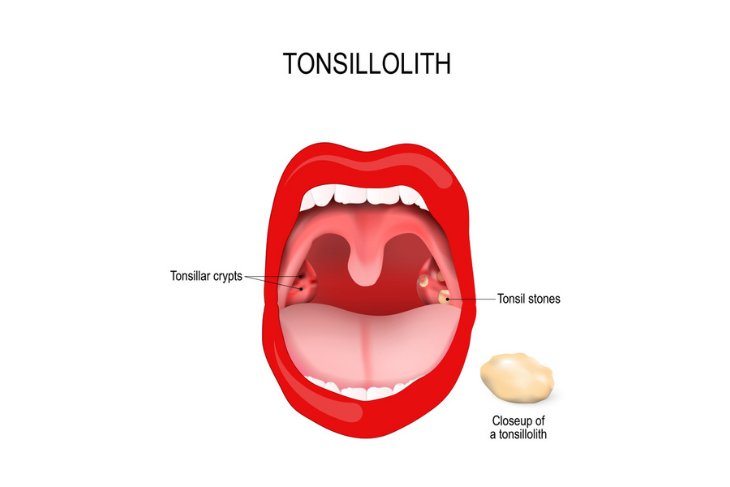 Tonsil yoga stones for Top 5