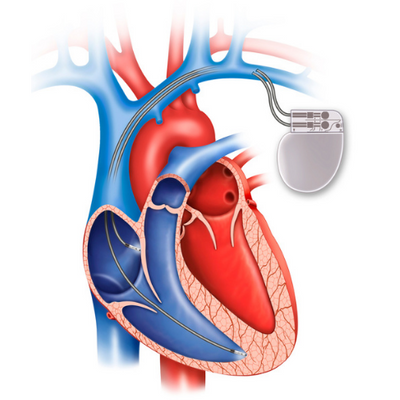 A Complete Guide to Living With a Pacemaker - ActiveBeat