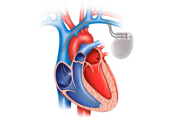 A Complete Guide to Living With a Pacemaker