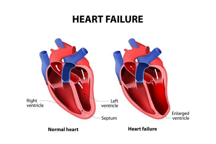 Coronary Artery Disease: Signs, Causes, and Treatment - ActiveBeat