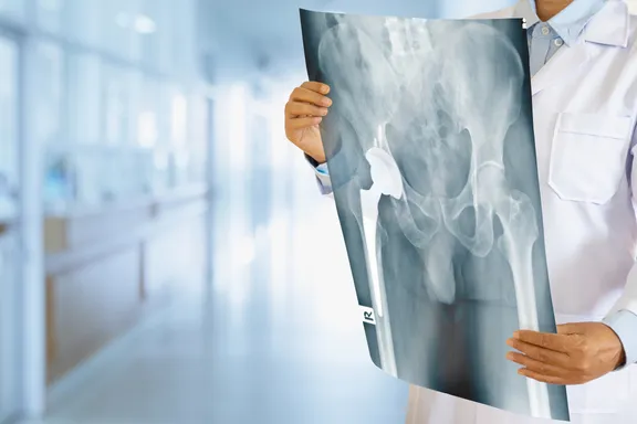 Hip Replacement Surgery: Purpose, Preparation, and Recovery