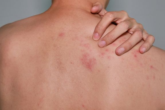 What You Need to Know About Shingles