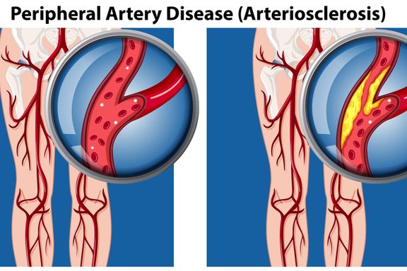 Peripheral Artery Disease (PAD): Symptoms, Causes, and Treatment