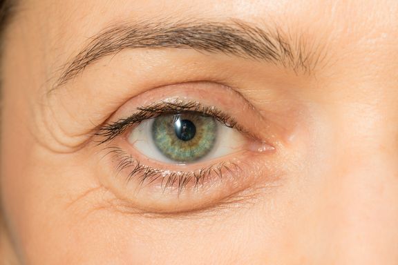 Puffy Eyes: What Causes Them and Ways to Get Rid of Them