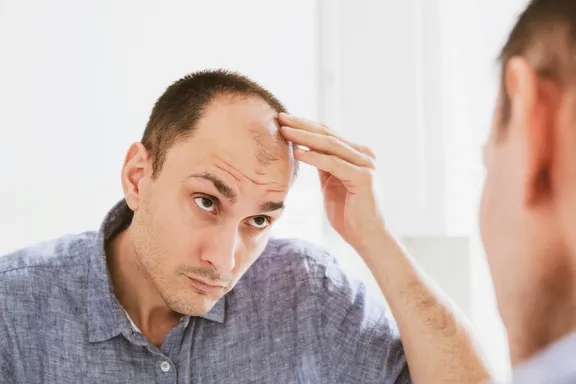 Male Pattern Baldness: Signs, Causes, and Treatments